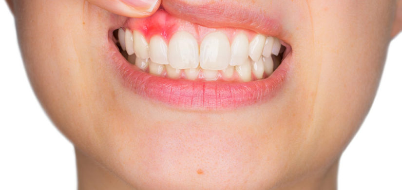 periodontitis-gingivitis-son-contagiosas (1)