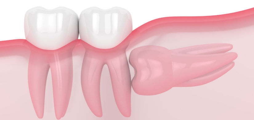 3d render of jaw with wisdom horizontal impaction over white background. Concept of different types of wisdom teeth problems.