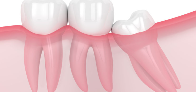 3d render of jaw with wisdom mesial impaction over white background. Concept of different types of wisdom teeth problems.