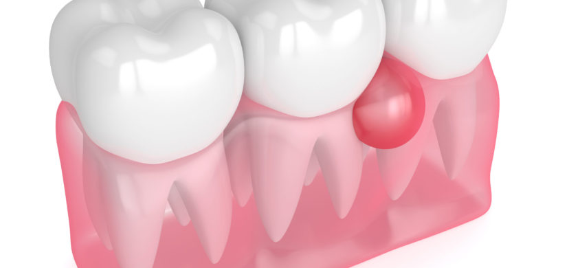 3d render of teeth in gums with cyst over white background. Dental problem concept.