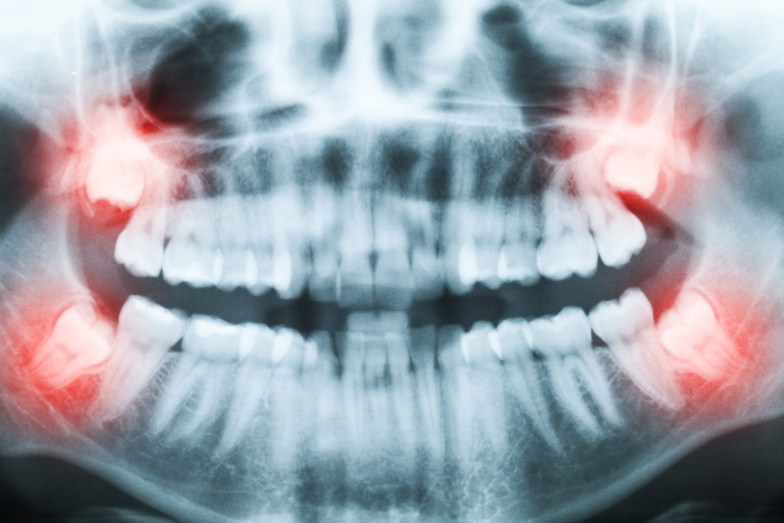 Primer plano de una imagen de rayos X de los dientes y la boca